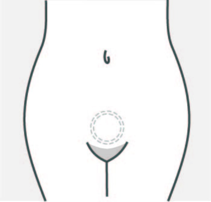 A minimal line illustration of a body outline showing the NuvaRing, on a black background